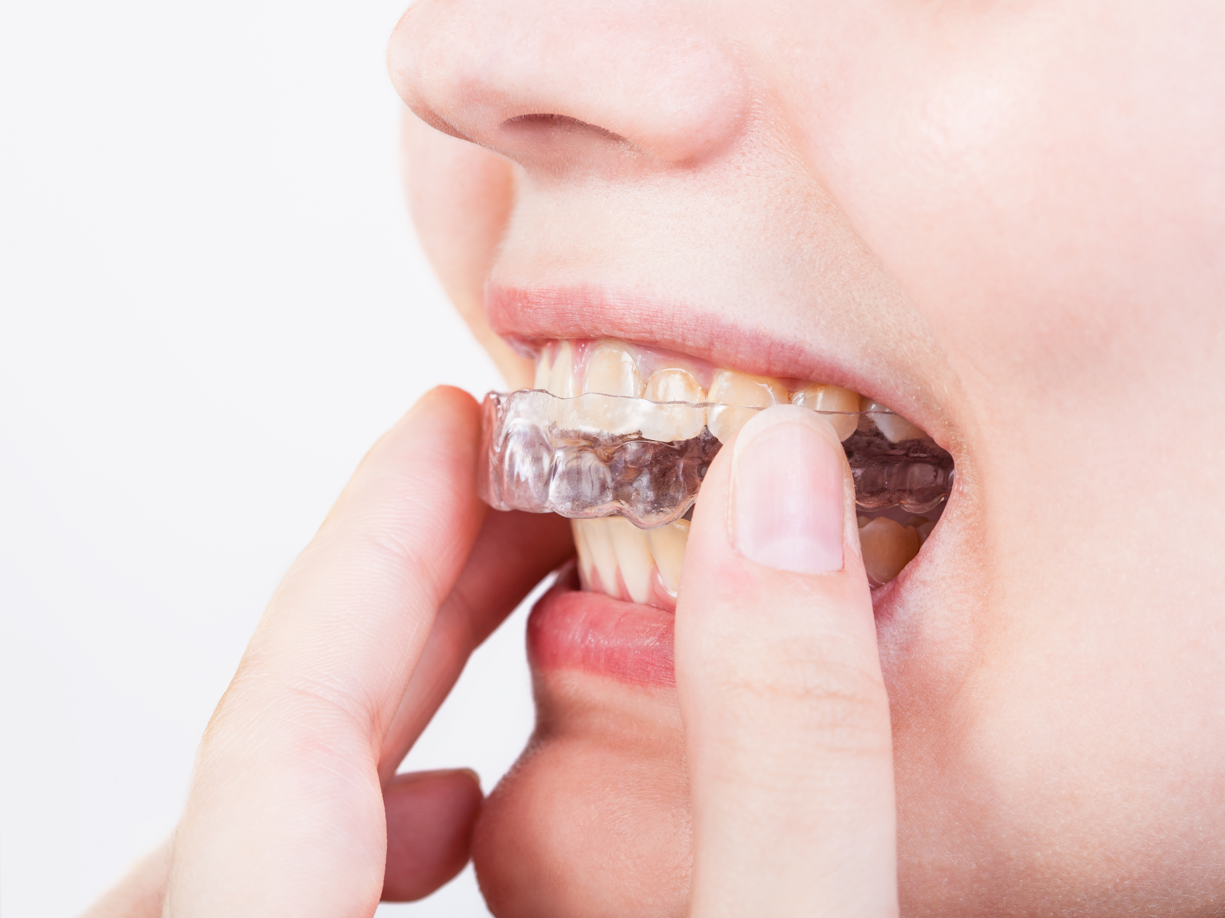 girl fixes transparent aligner for dental treatment