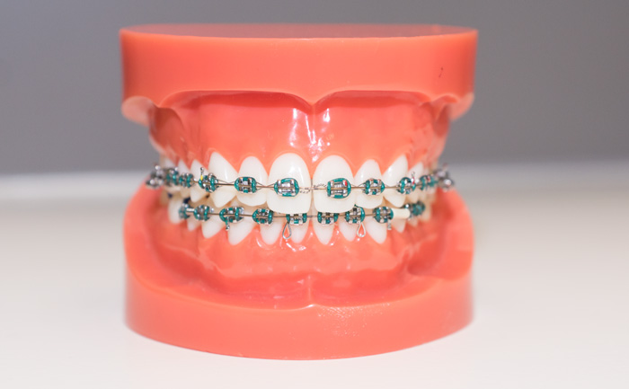 Vaste beugels - Orthodontist Dukenburg. Alles over beugels en orthodontie.